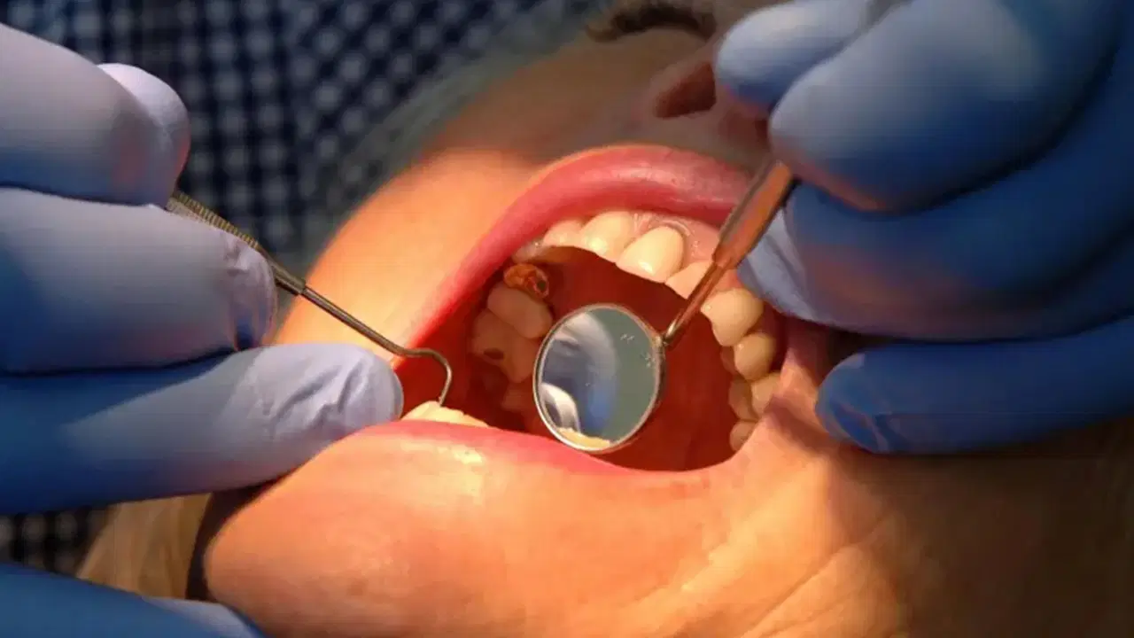 dis minesini onaran yeni jel curuklerin sonu mu geliyor unTngqPm.jpg